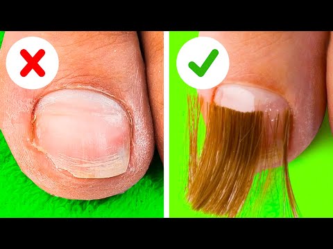 Broken nail restoration. Smart Manicure And Pedicure Hacks