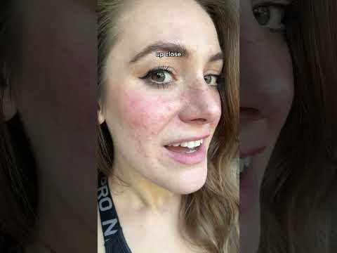 skin – social media vs reality 👀 #skinpositivity #bodyacceptance