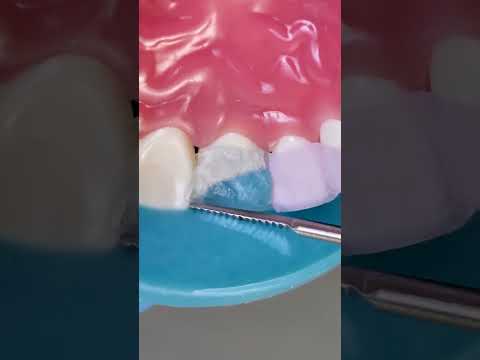 Why Is Anything Dental So Expensive? 🦷 Watch How Do They Fix a Chipped Tooth